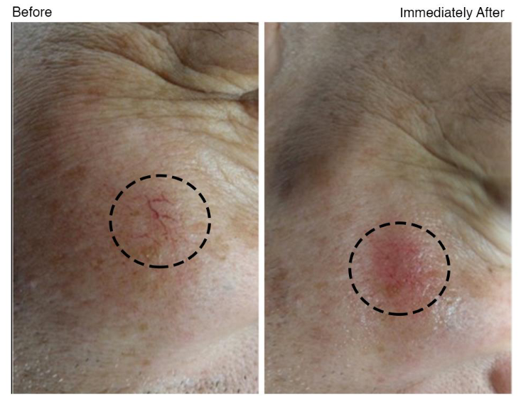 Screenshot_2022-04-03_at_07-49-02_Vascular_Lesions_Management_and_Telangiectasia_Cauterization_with_Innovative_Long_Pulse_N