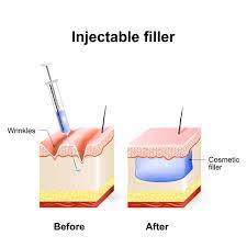 inyectable-filer