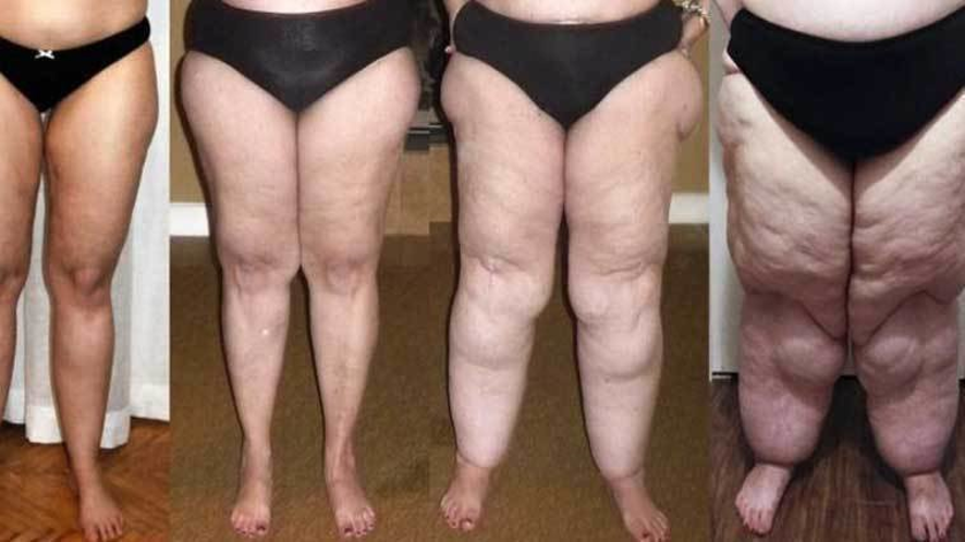 lipedema