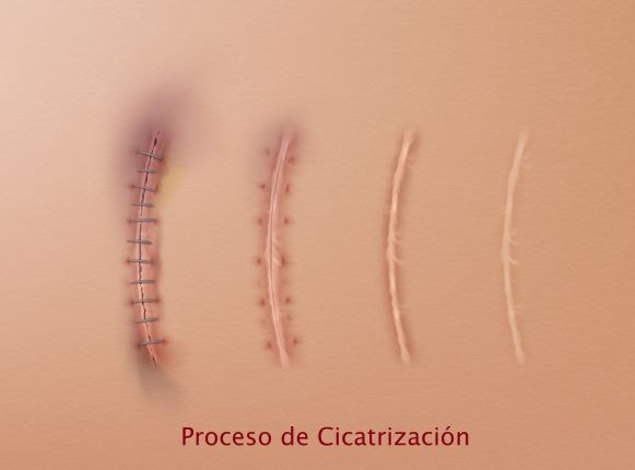 proceso-de-cicatrizacin-de-la-piel